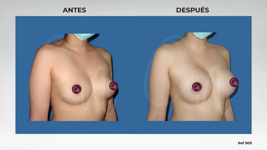 Aumento mamario caso de antes y después