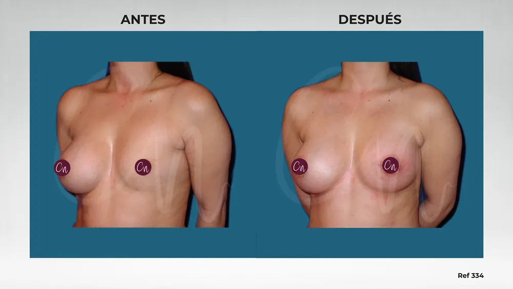 corrección del síndrome de poland mamario antes y después