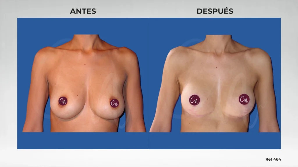 caso antes y después pexia mamaria o mastopexia sin prótesis mamarias ref 464