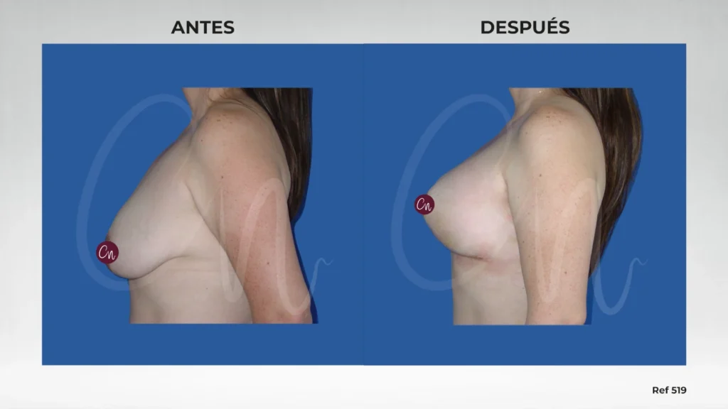 caso antes y después pexia mamaria o mastopexia sin prótesis mamarias ref 519