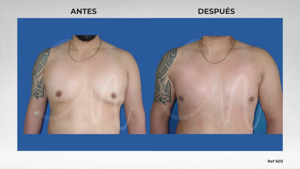 caso antes y después cirugía postbariátrica