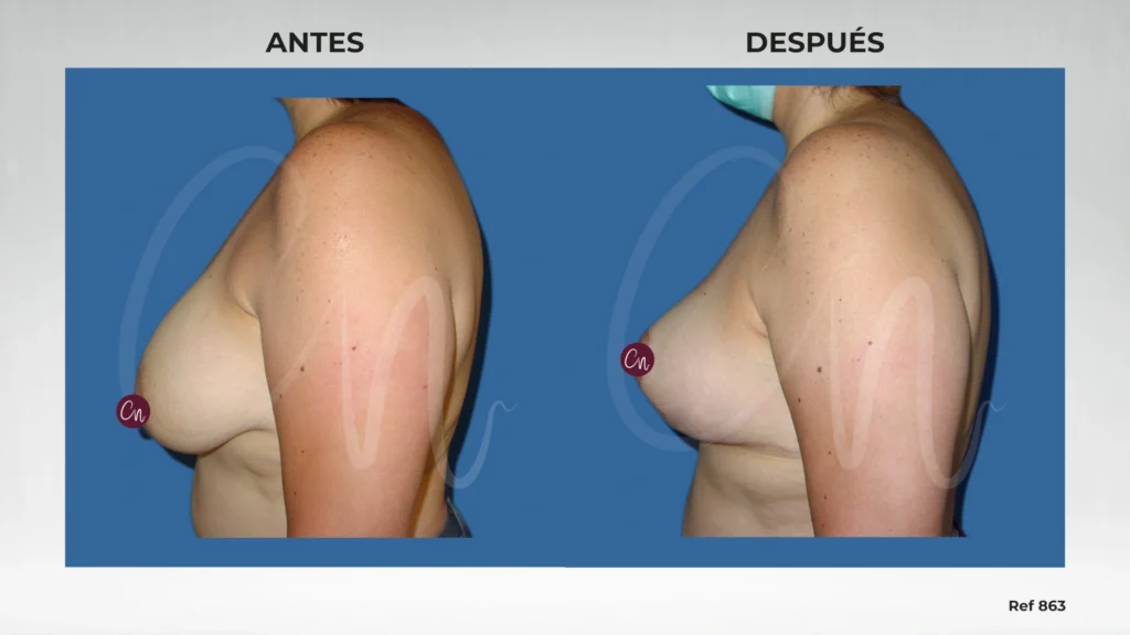 caso de antes y después mamoplastia reductiva