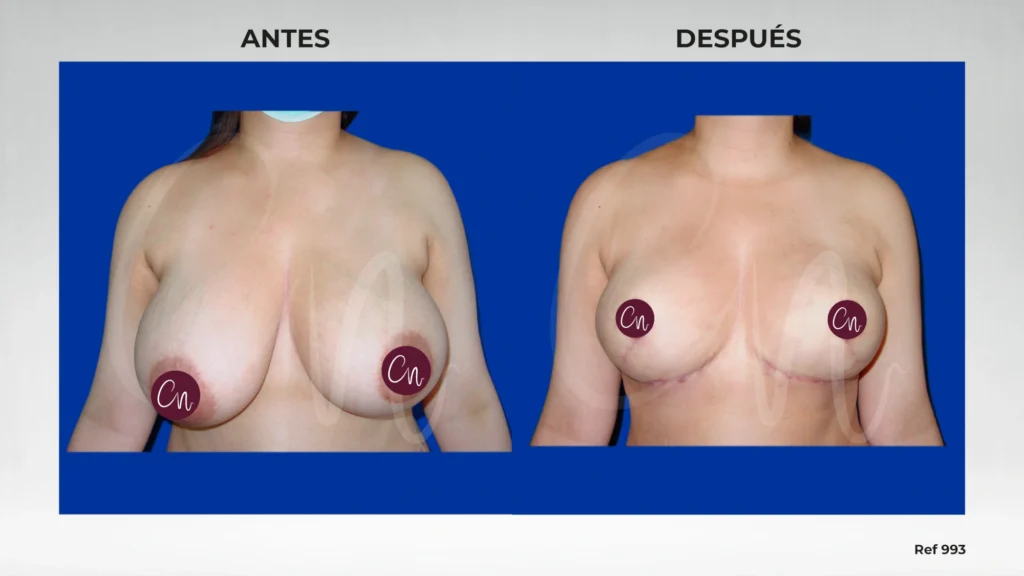 caso de antes y después mamoplastia reductiva