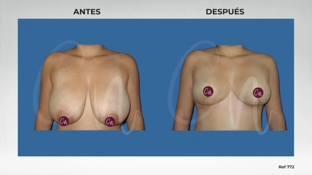 caso de antes y después Reducción mamaria