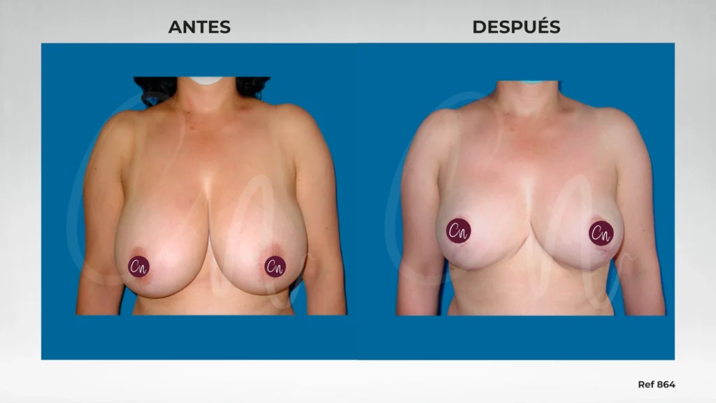caso de antes y después Reducción mamaria
