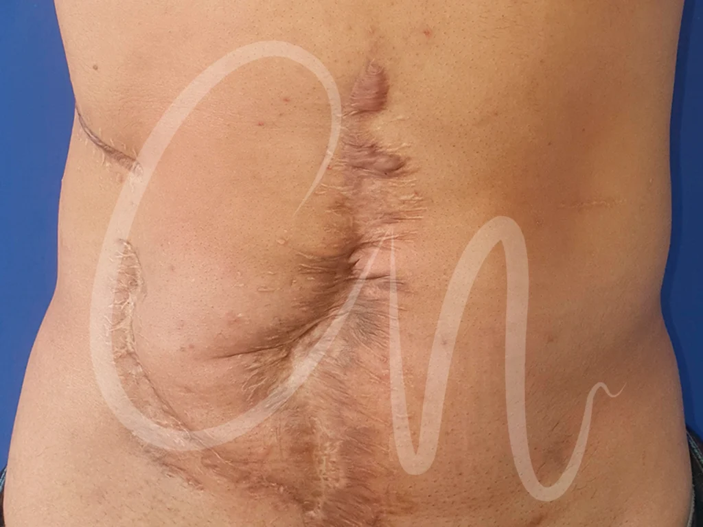 Cicatriz: ¿Cómo disimularla en una abdominoplastia?