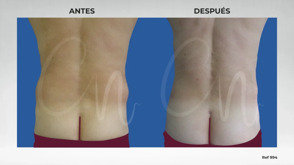 Casos de antes y después en liposucción de espalda o lifting de espalda