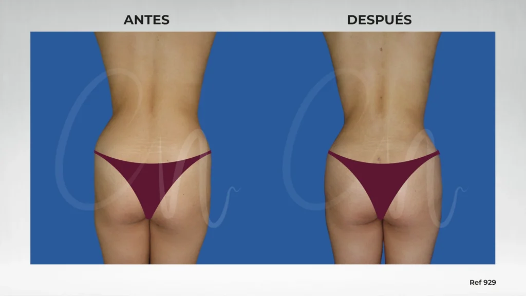 Casos de antes y después en liposucción de espalda o lifting de espalda
