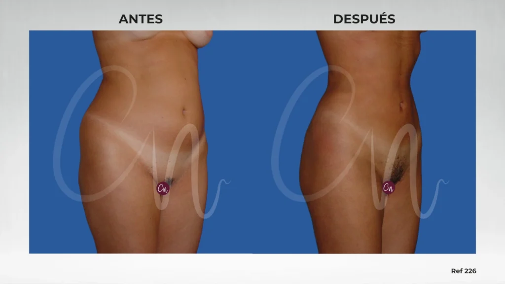Casos antes y después en cirugía de reducción cintura