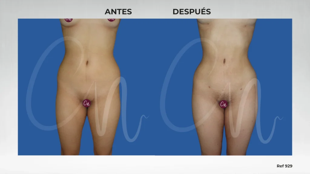 Casos antes y después en cirugía de reducción cintura