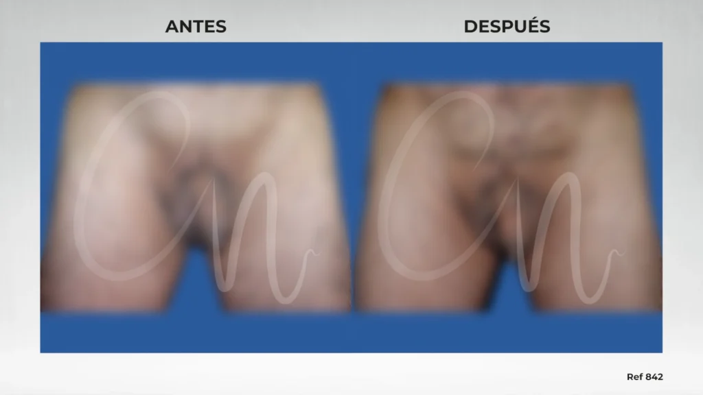 Casos de antes y después sobre implante testicular o prótesis testicular
