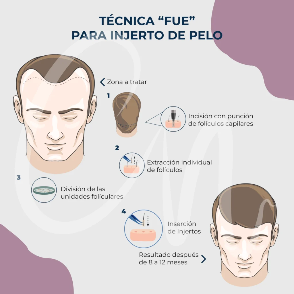 ¿Cómo se realiza una cirugía plástica de injerto de pelo o trasplante capilar?