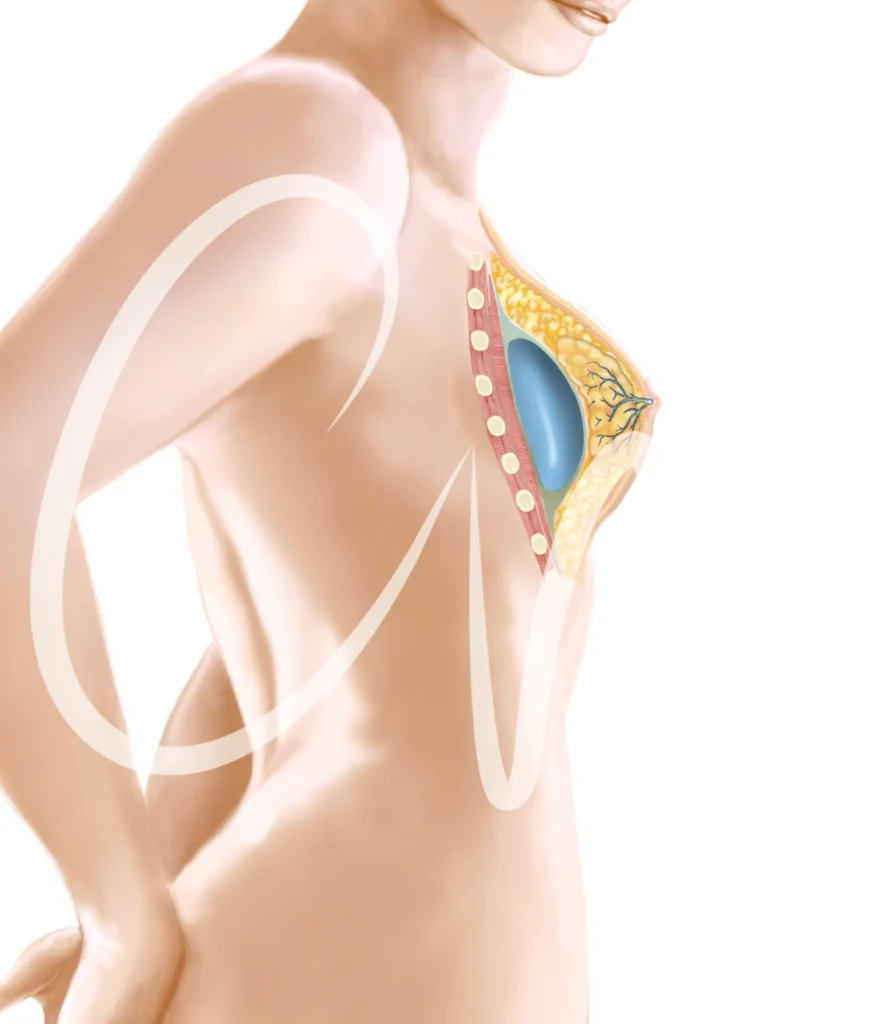Implante mamario 
subfascial