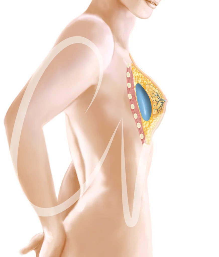 Implante mamario 
submuscular