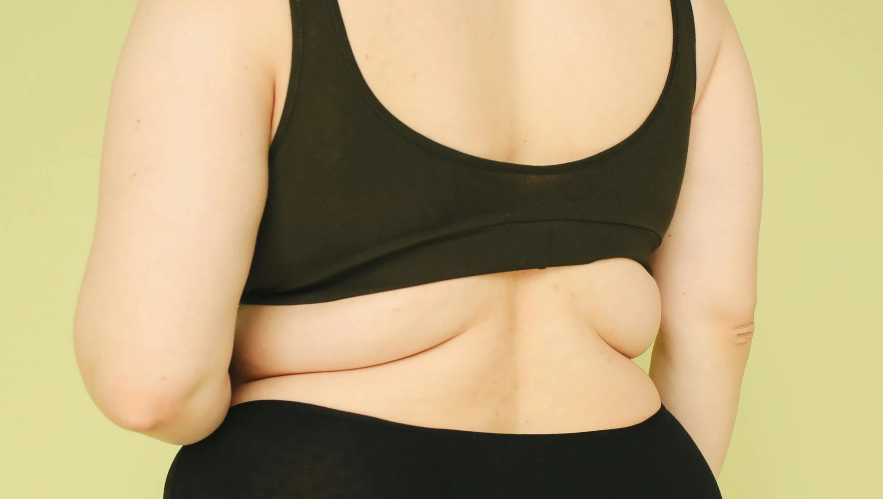 Cicatrices después de una liposucción