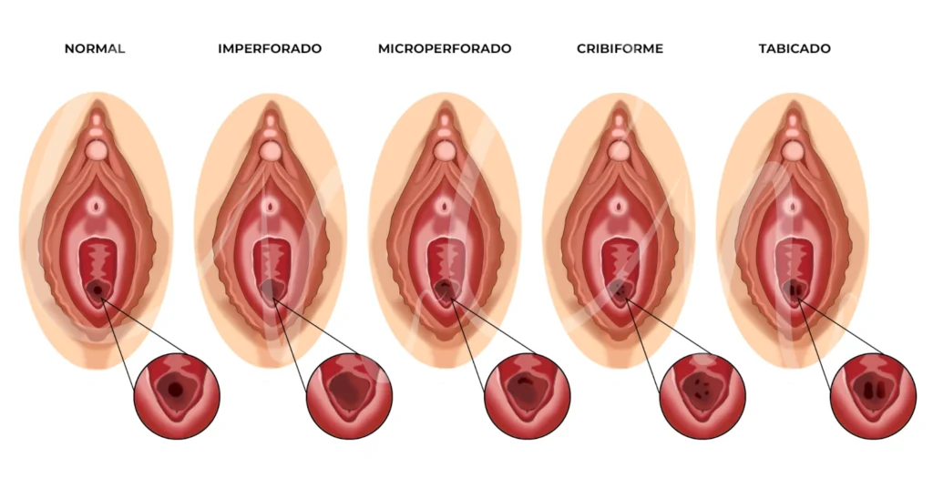 Tipos de himen