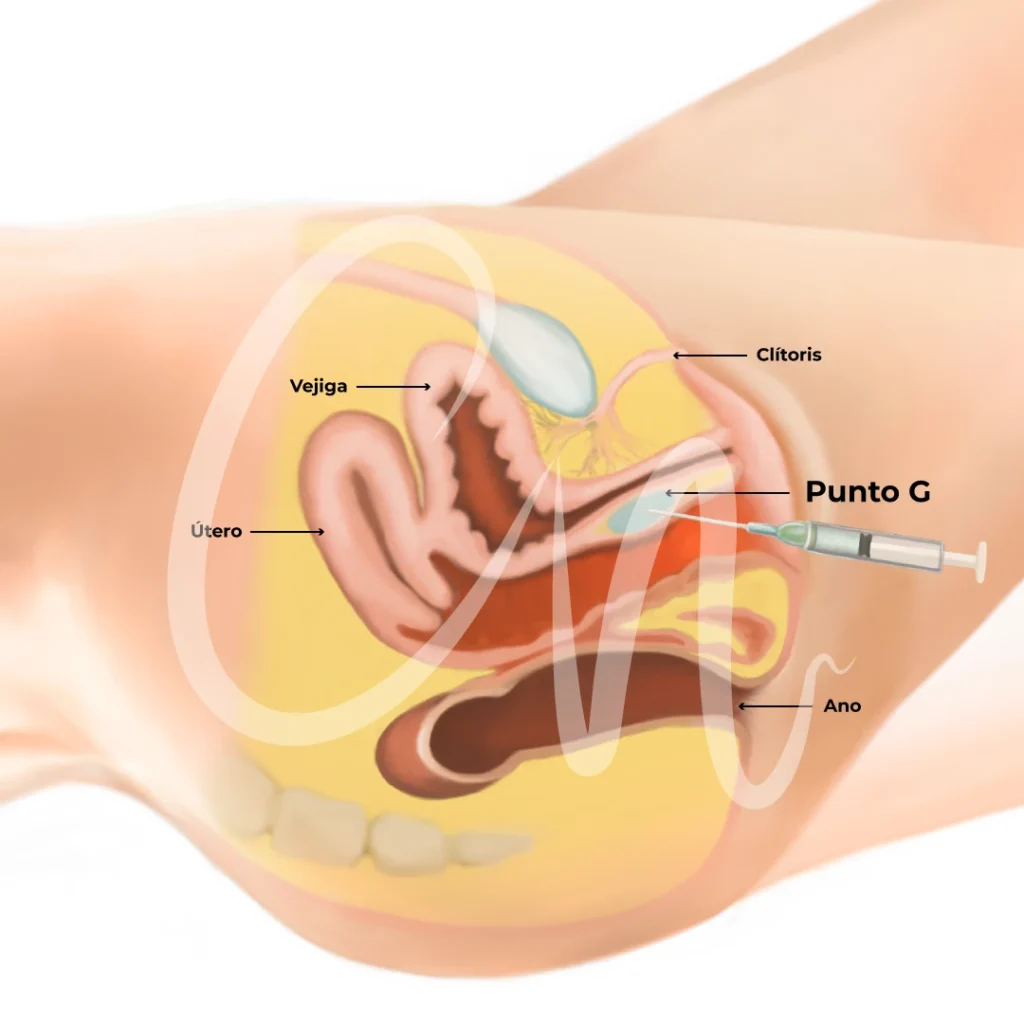 ¿Qué hace el Bótox en el punto G o zona genital interna?