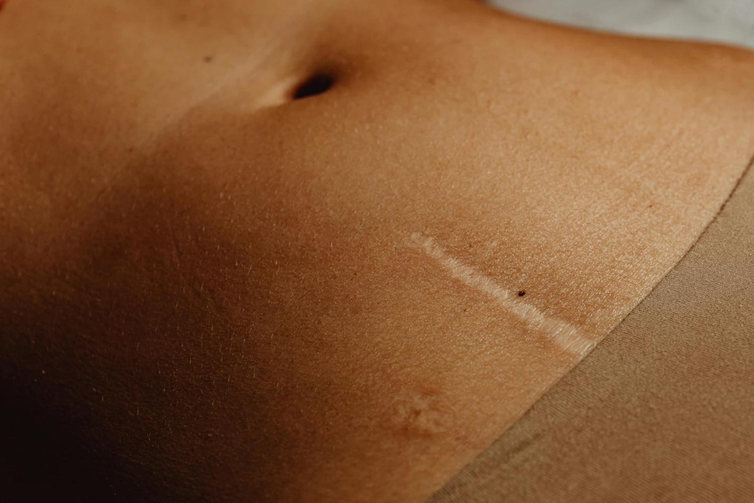 Cicatriz por lipectomia