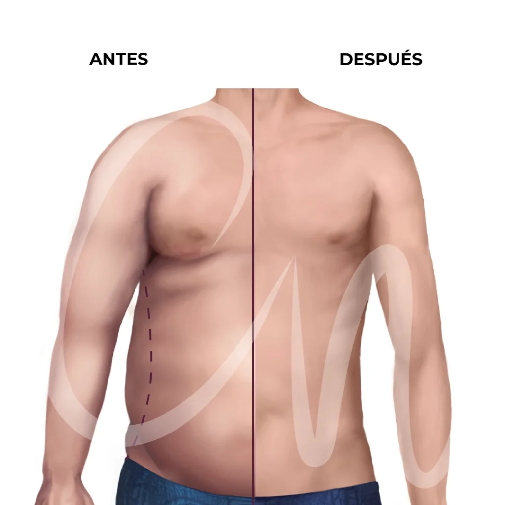 flancos masculinos, flancoplastia 