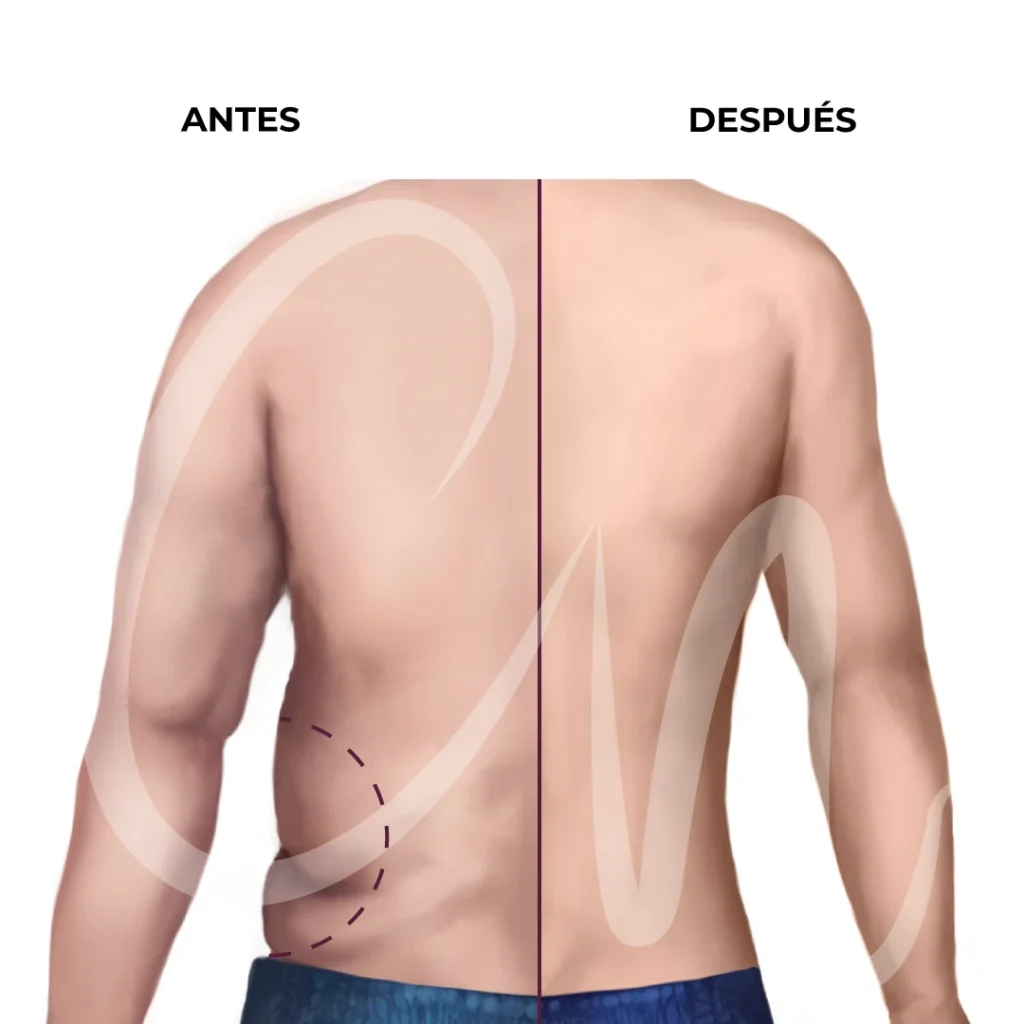flancos masculinos, flancoplastia 