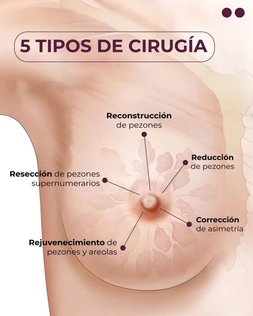 Tipo de cirugía en pezones y areolas