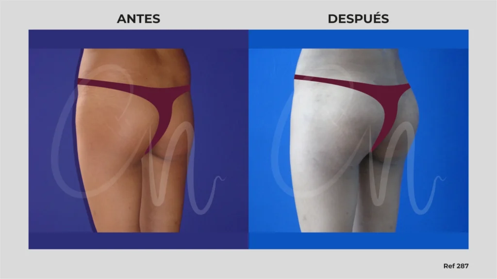 antes y después aumento de cola con prótesis