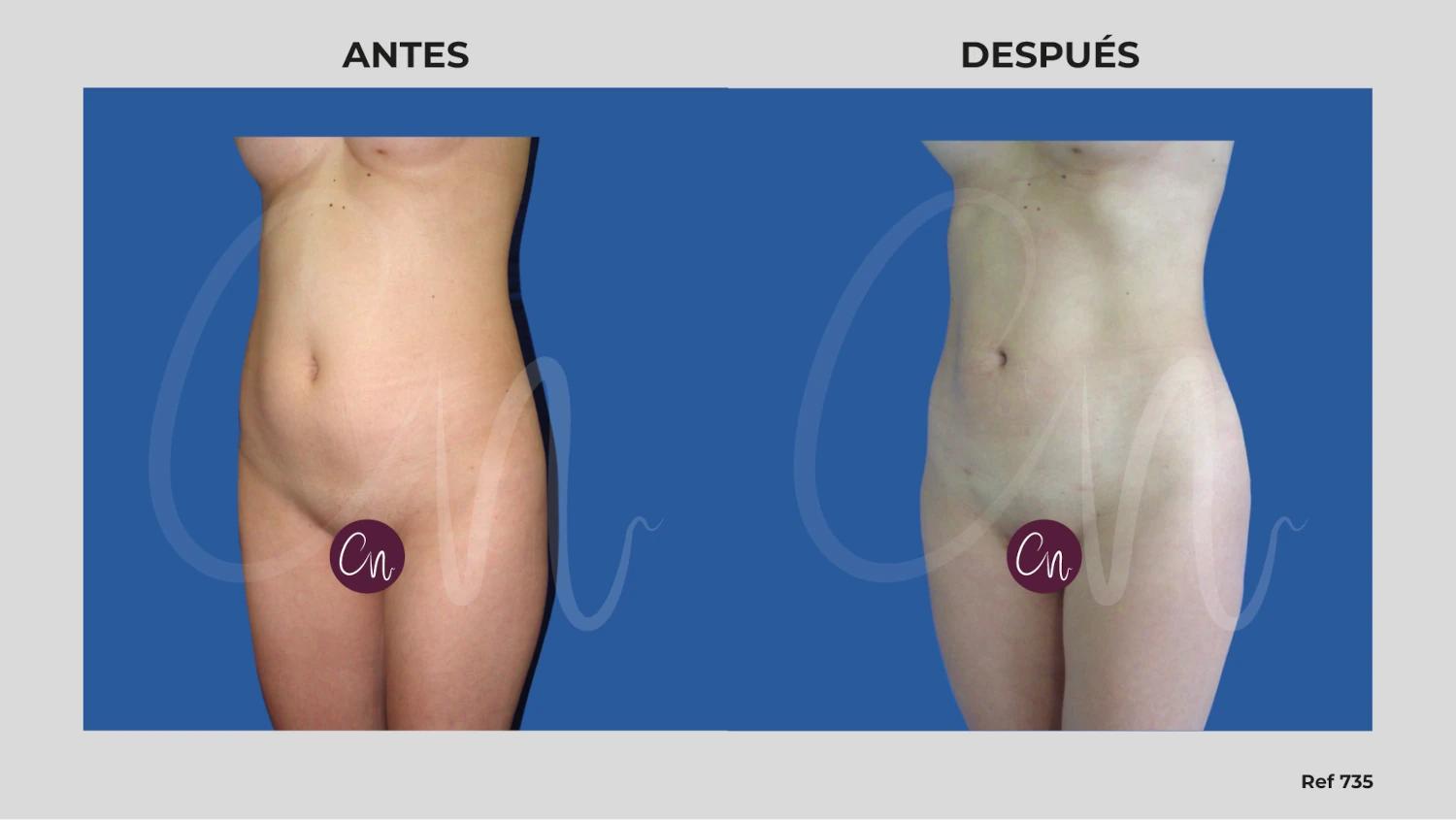 antes después lipo liposucción