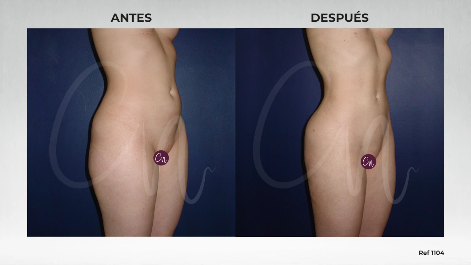 antes después liposucción lipoescultura