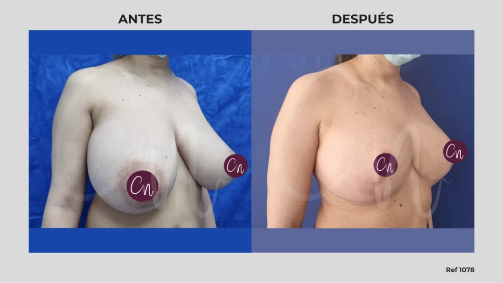 antes y después asimetría en los senos