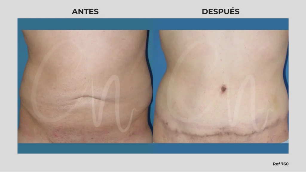 antes y después cirugía del ombligo
