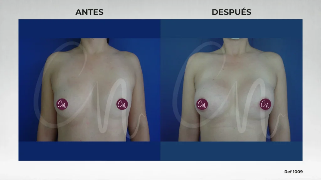 antes y después corrección asimetría mamaria