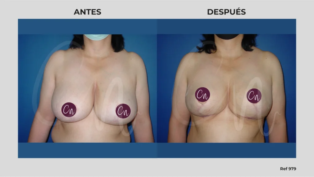 antes y después corrección asimetría mamaria
