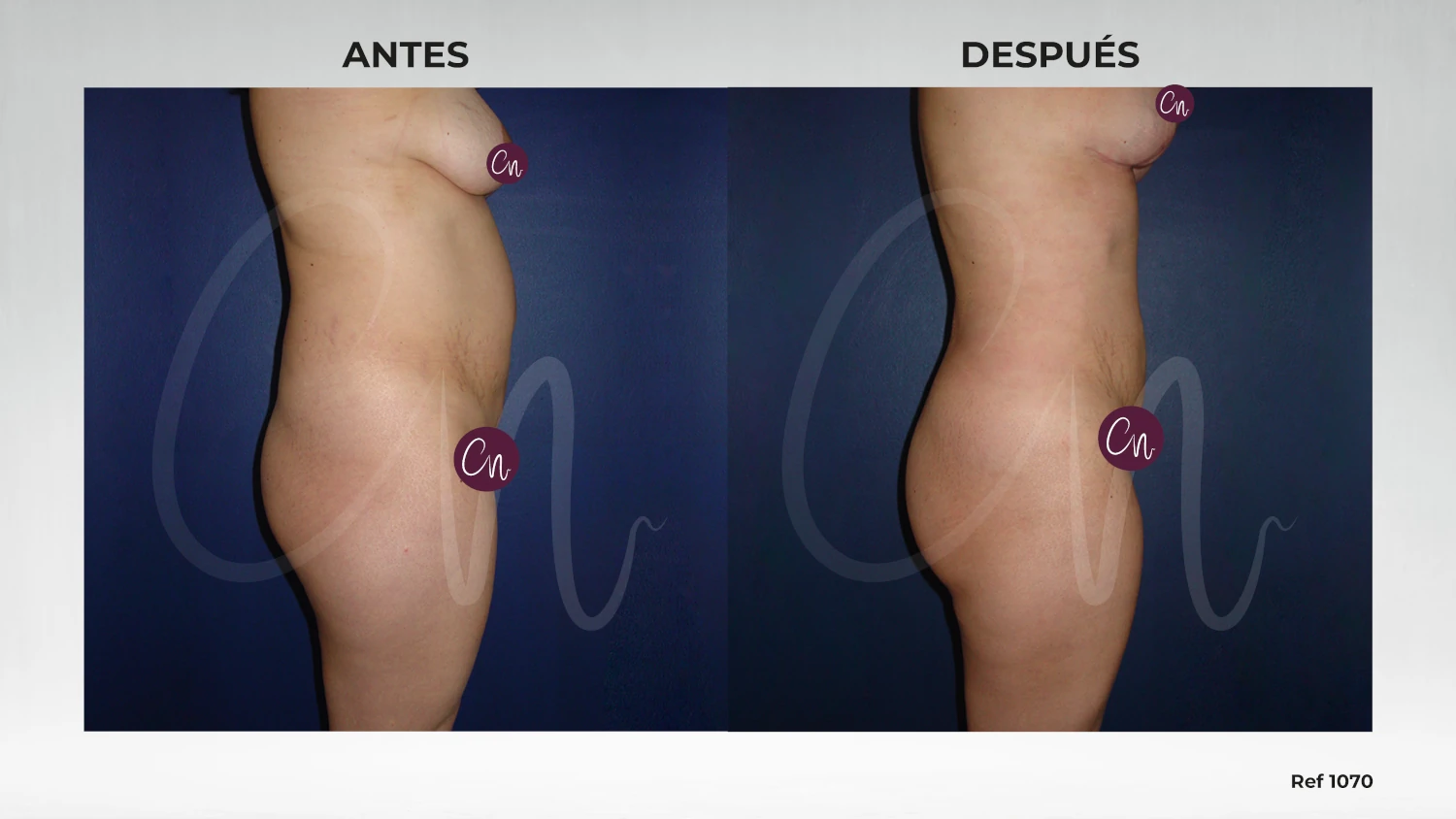 antes y después lipoescultura
