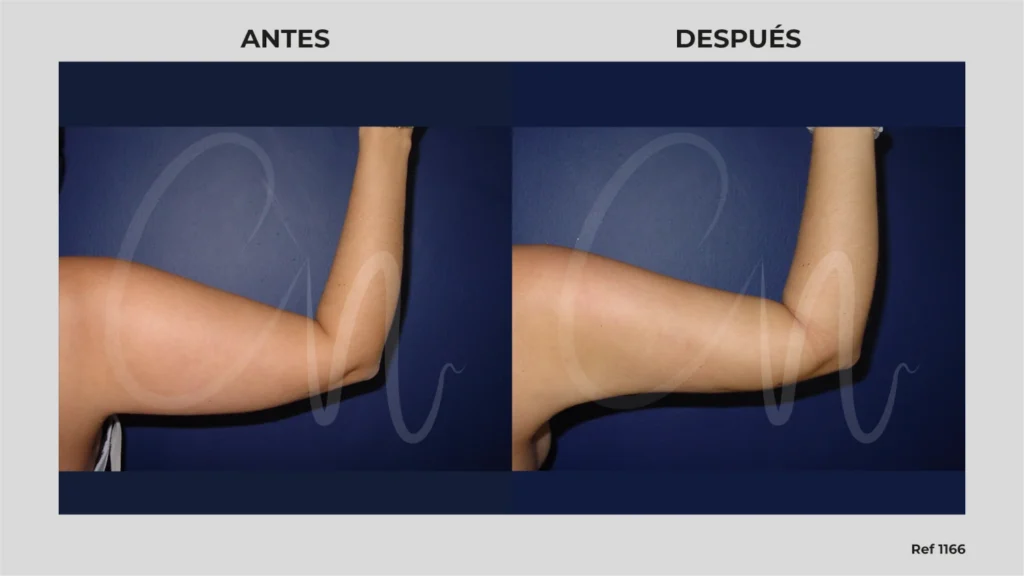 antes y despues liposuccion de brazos caso