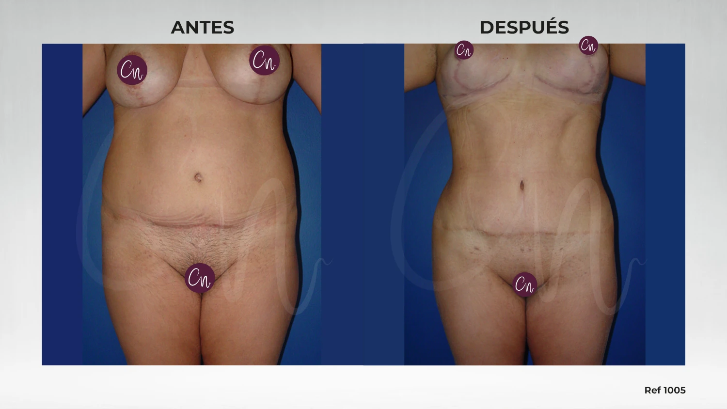 antes y después liposucción
