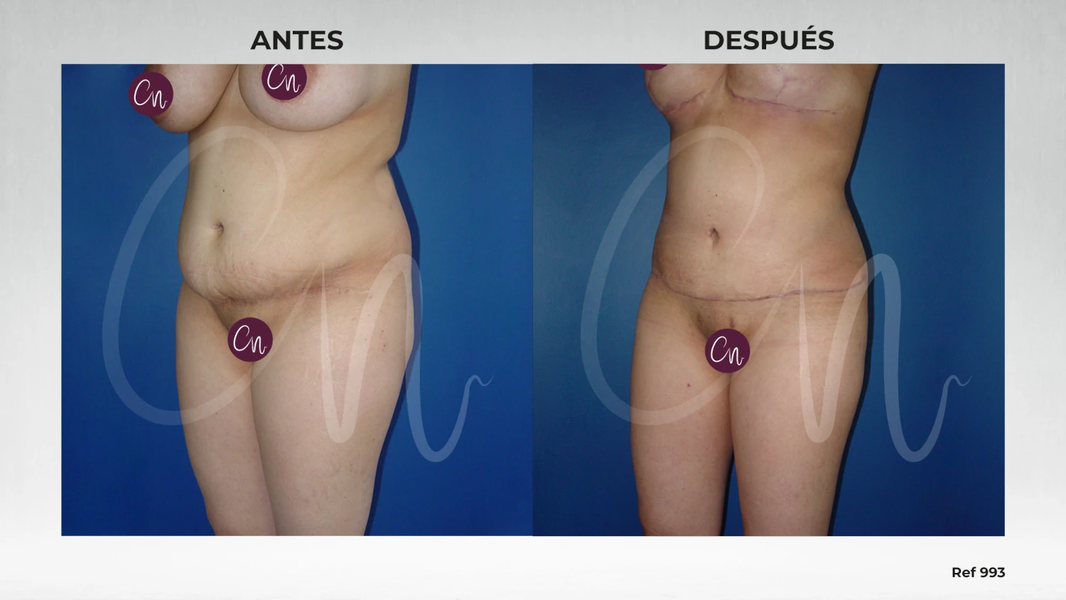 antes y después miniabdomen