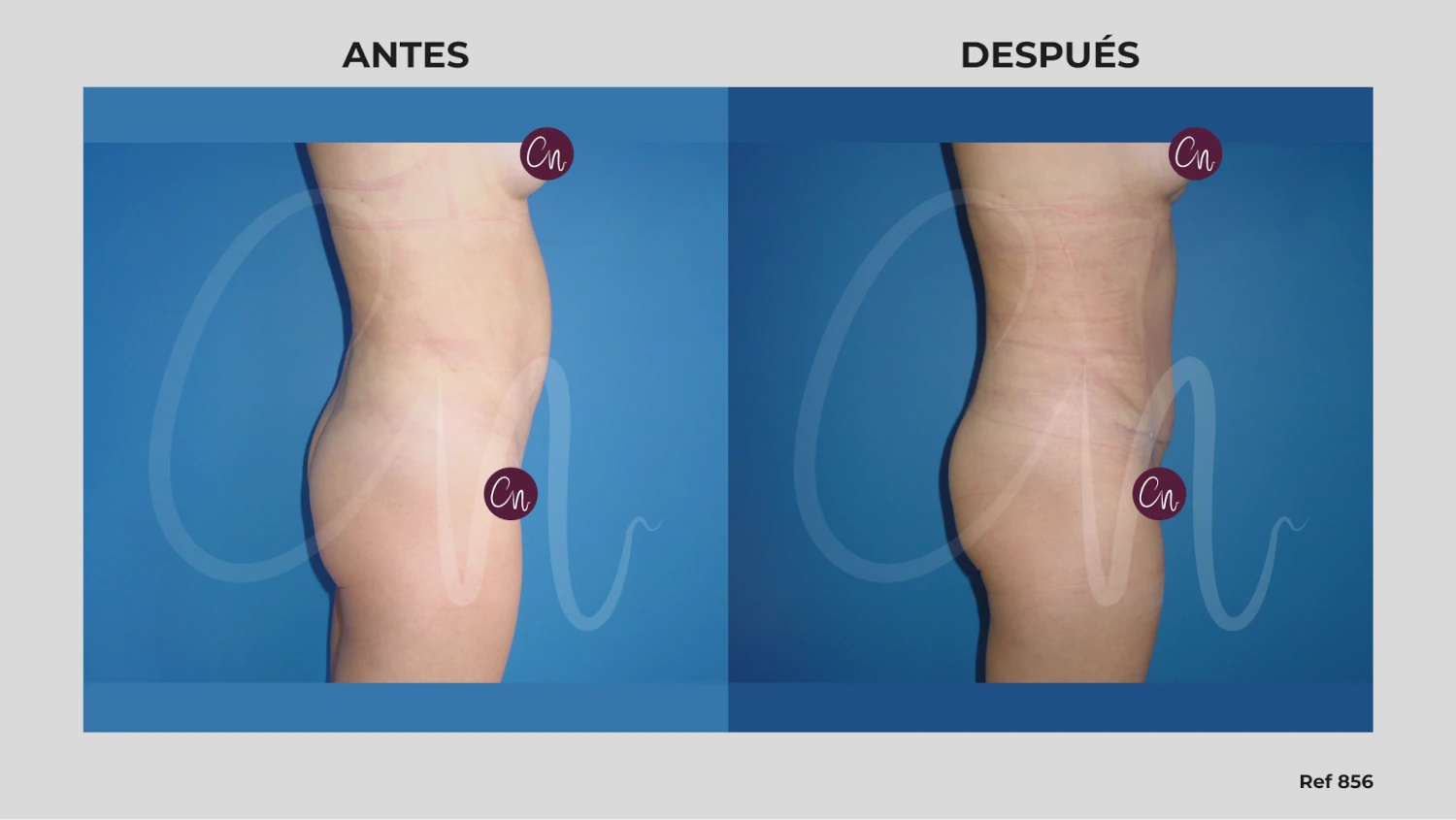 antes y después miniabdominoplastia