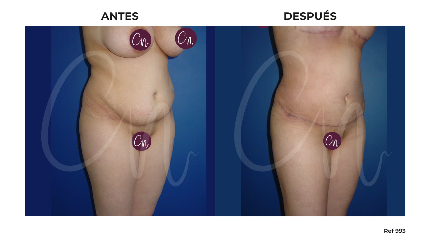 antes y después miniabdominoplastia