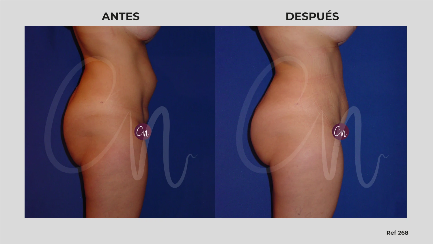 antes y después minilipectomia