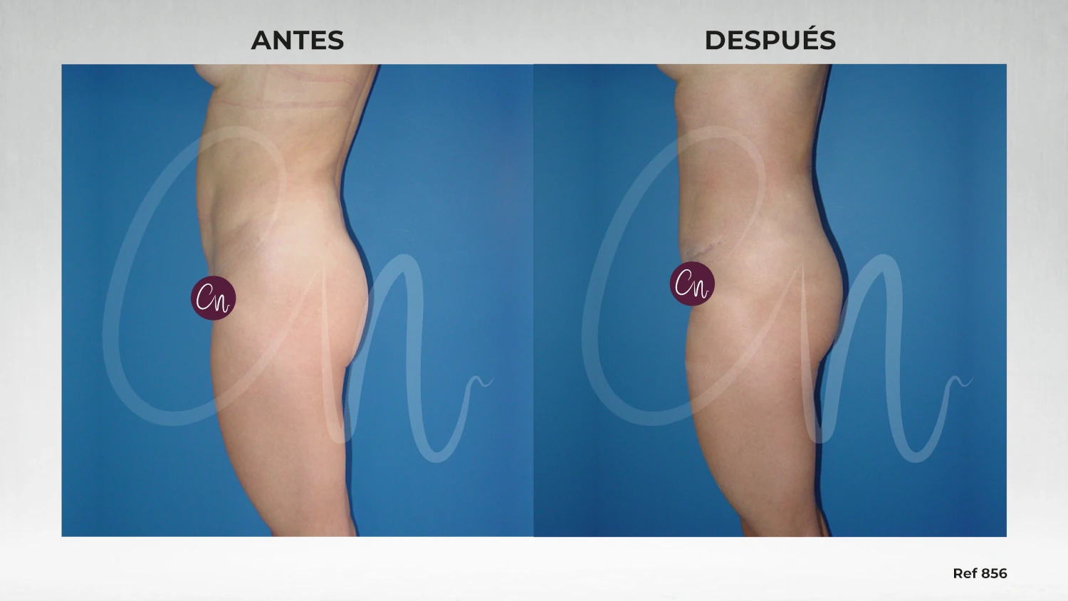 antes y después minilipectomia