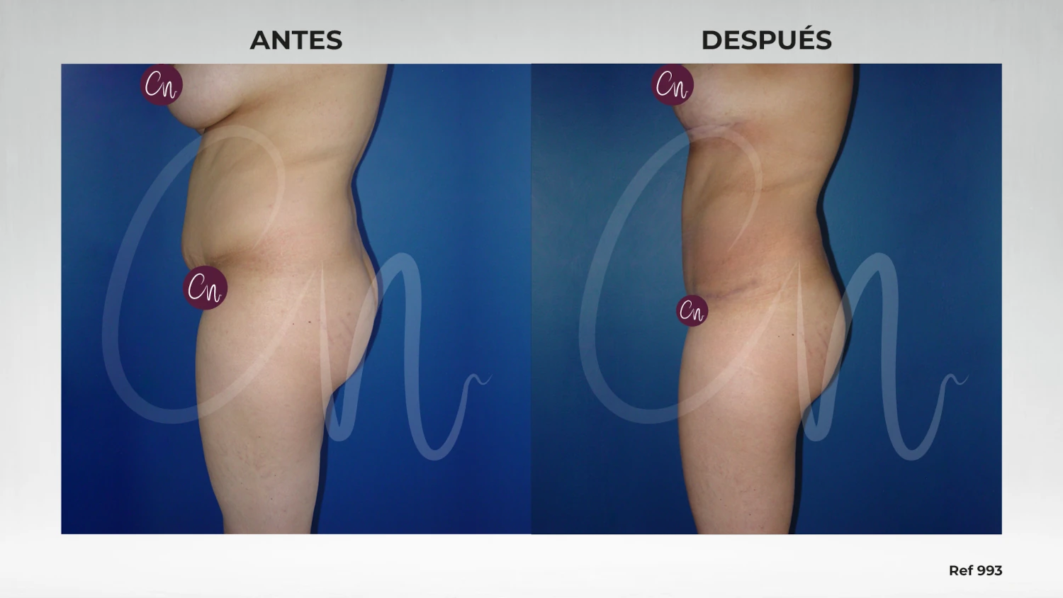 antes y después minilipectomia