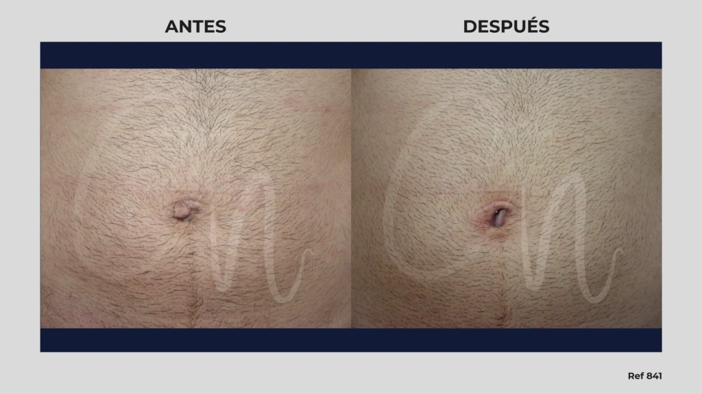 antes y después reconstrucción del ombligo