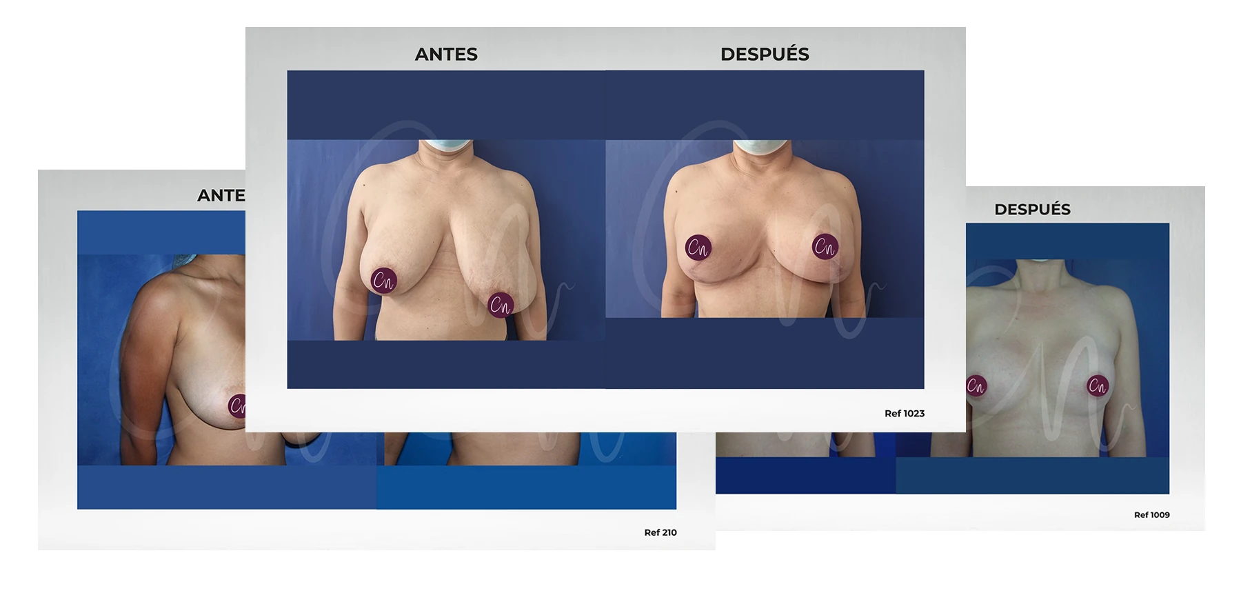casos Antes y después corrección asimetría mamaria