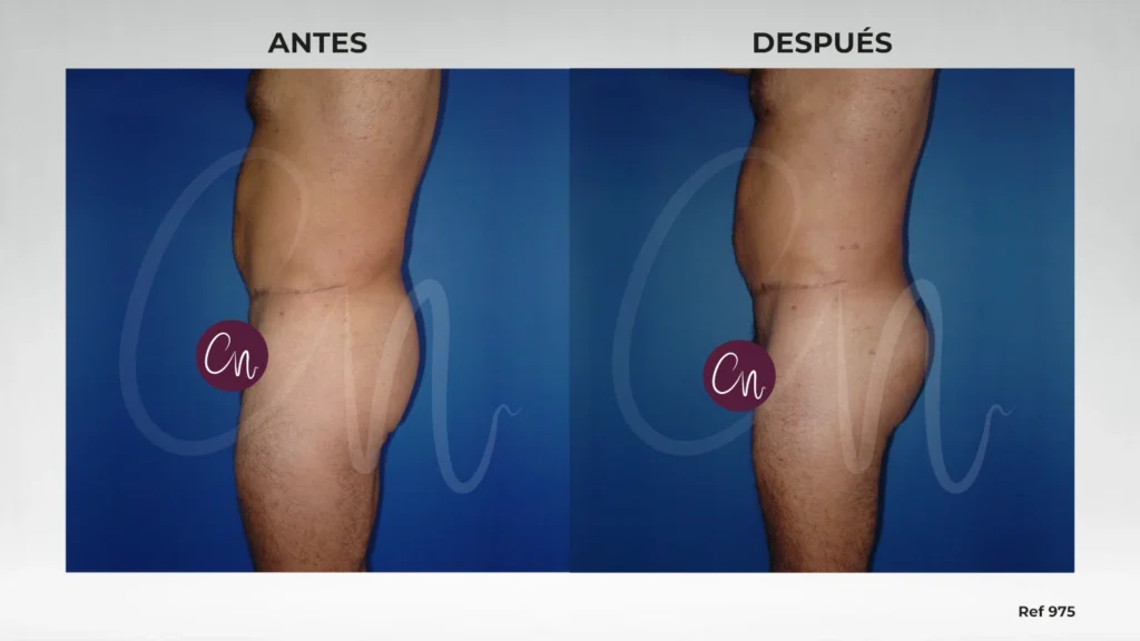 aumento de glúteos con implantes hombre