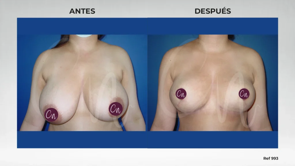 caso asimetría en los senos