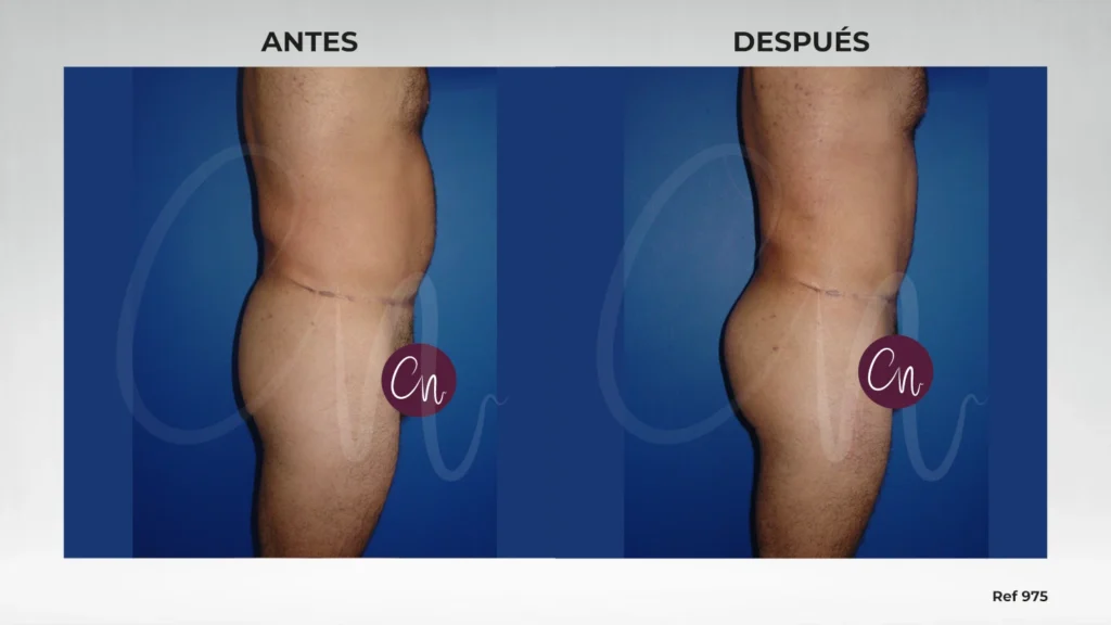 caso implantes de glúteos antes y después