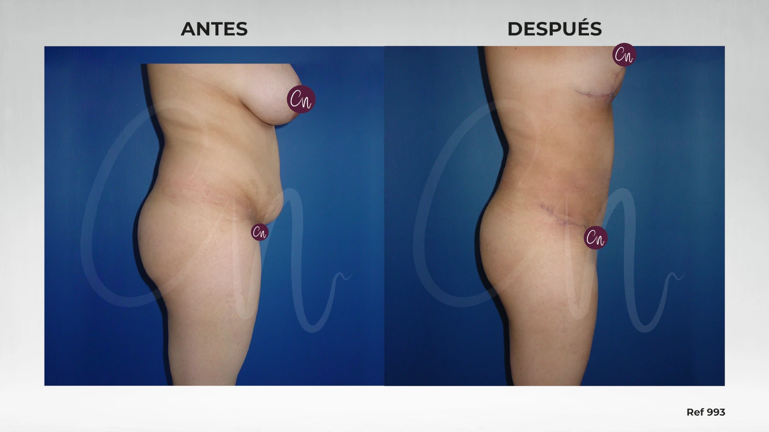 caso recorte de abdomen - MiniLipectomia