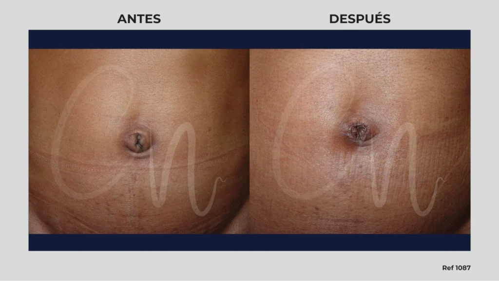 caso umbilicoplastia