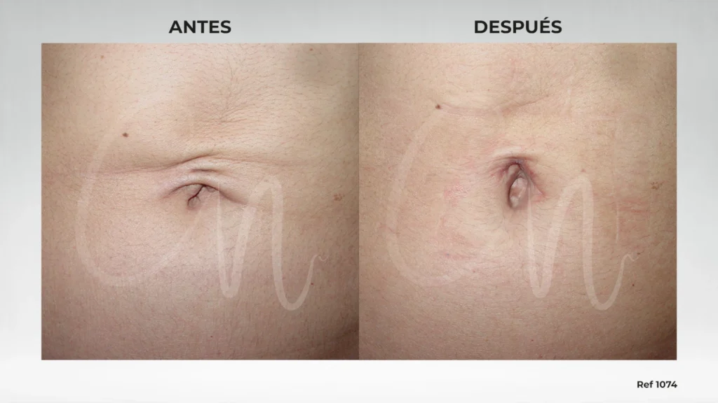 foto cirugía umbilical