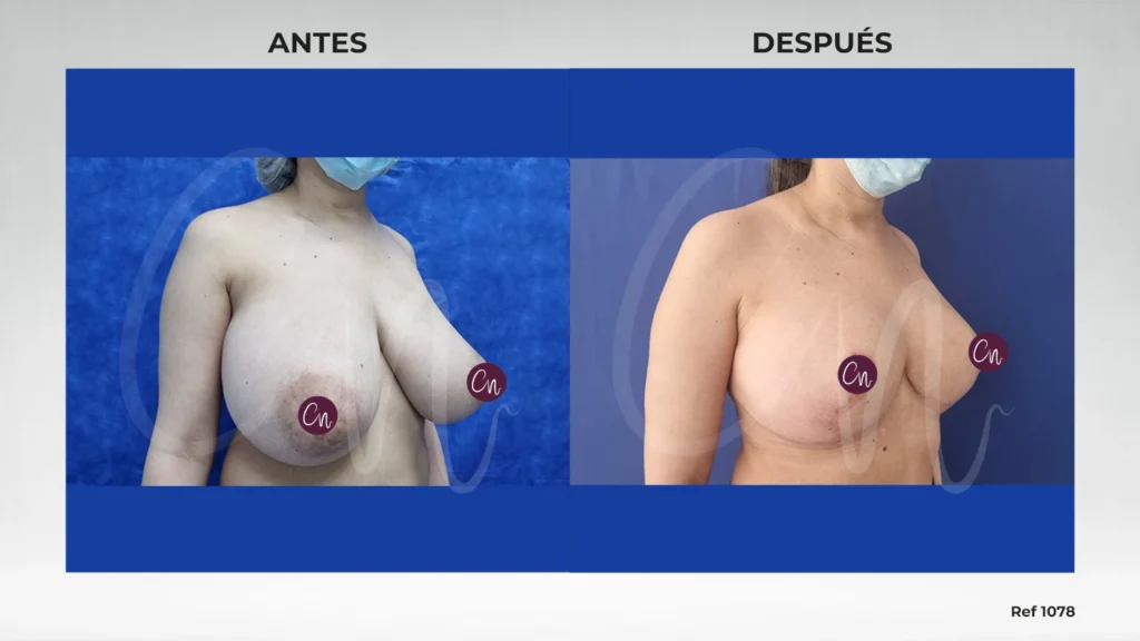 corrección de asimetría mamaria